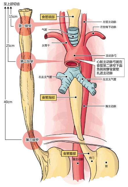 男子被巨大鱼刺扎入心脏，幸运获救