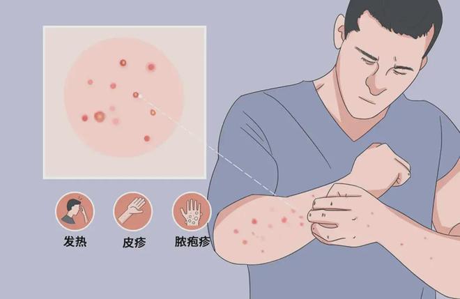 猴痘，了解、预防与控制的全面指南