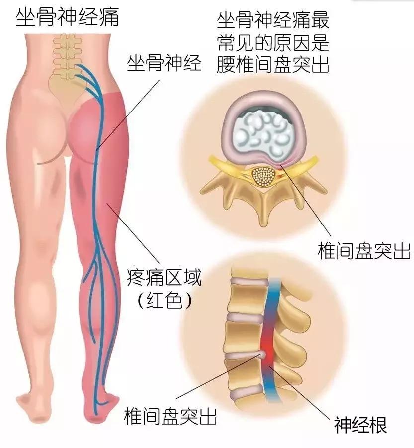 4岁孩子被妈妈打屁股致脊髓损伤